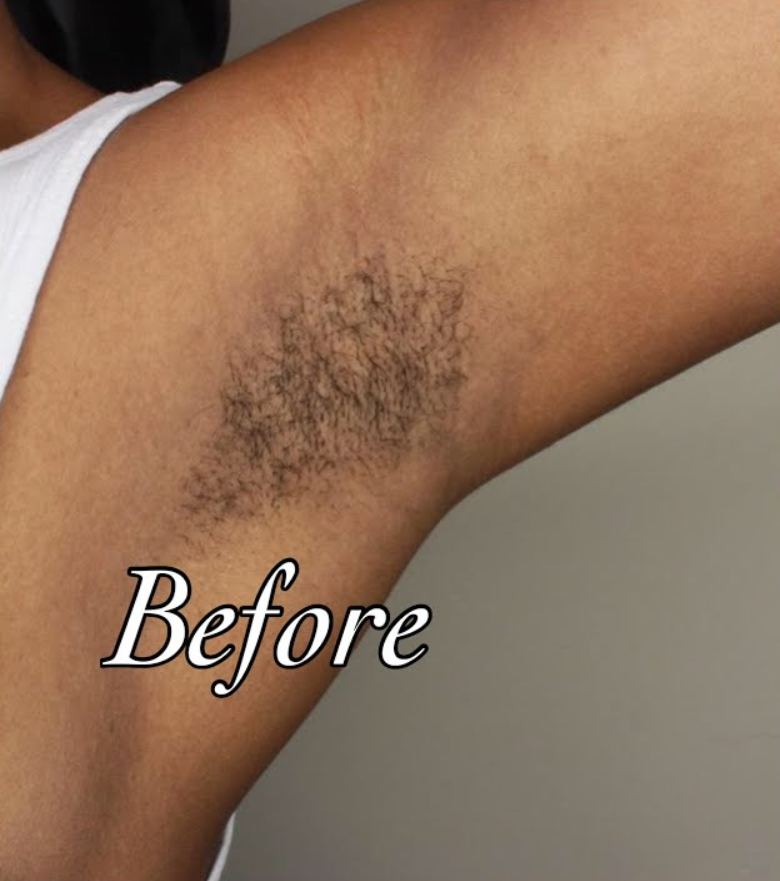 No-shave Body Hair Removal Cream